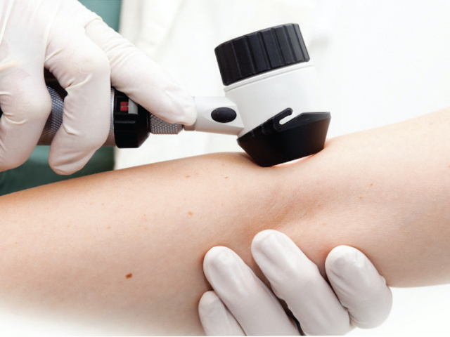 Photo of Melanoma-Monday